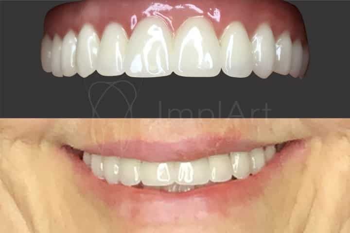 How do I get a dental implant? Implants